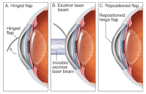 LASIK Photo